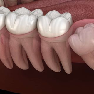 affordable wisdom tooth extraction singapore profile picture